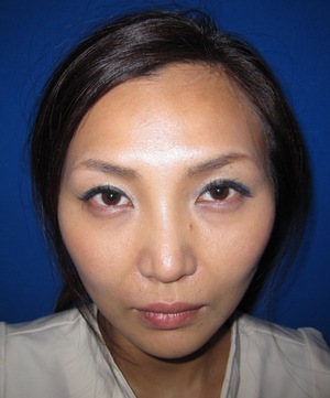 目の下のたるみ、目のくまでお悩みの方、切らずに完璧に解決します。TCB-R法　手術直後　症例写真